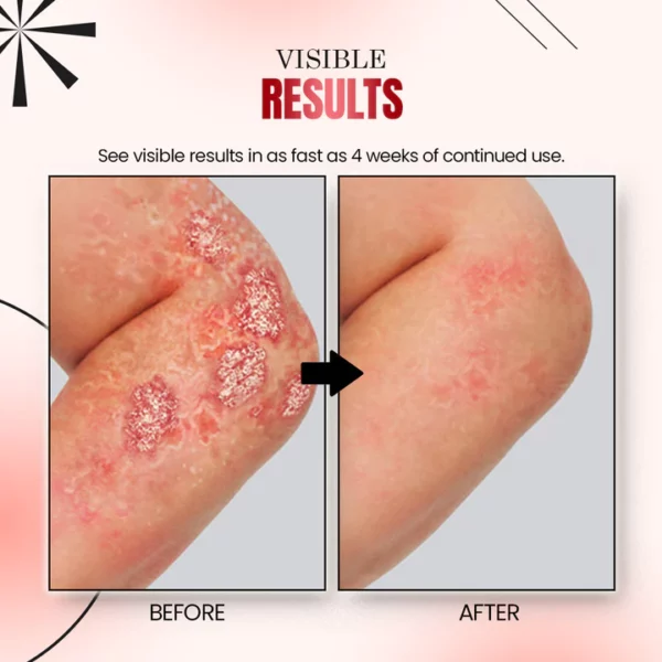 Psoriatrax Psoriasis Relief Spray