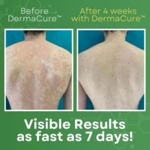 DermaCure™ Psoriasis Cream