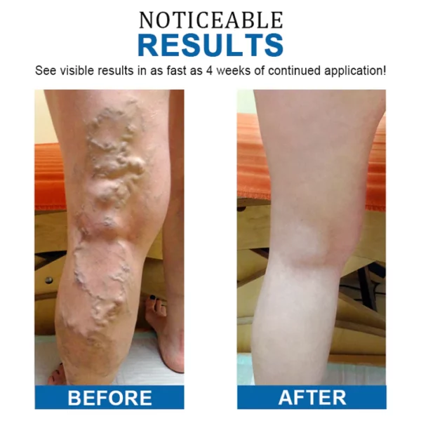 TrimVein™ Varicose Vein Care and Slimming Cream