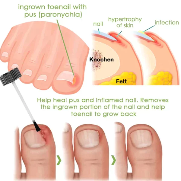 Voilaist™ Removal Paronychia Gel