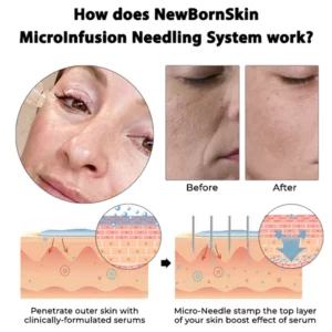 Oveallgo™ NewBornSkin MicroInfusion Needling System