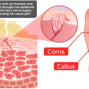 GFOUK™ IHerbal Foot Callus And Corns Removal Soak