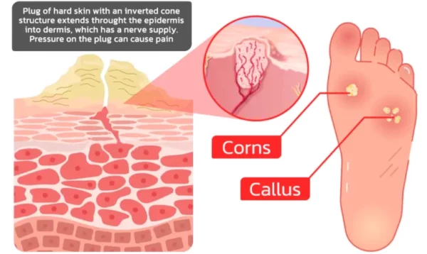 GFOUK™ IHerbal Foot Callus And Corns Removal Soak