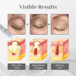 Ceoerty™ Milia Erase Lifting Eye Gel