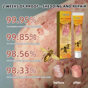 🐝EdiJonah® Bee Venom Psoriasis Treatment Cream-2023(Suitable for all skin conditions)