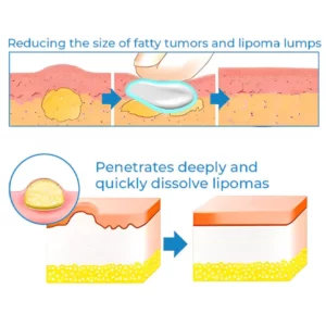 CurSkin™ Lipoma Treatment Ointment