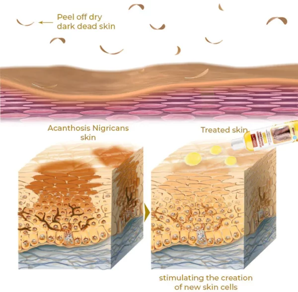 GFOUK™ Acanthosis Nigricans Peeling Oil