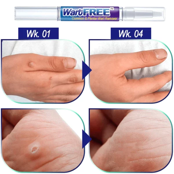 WartFREE™ Common & Plantar Wart Remover