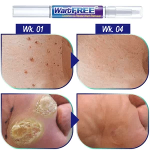 WartFREE™ Common & Plantar Wart Remover