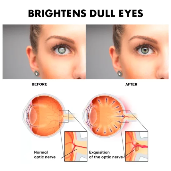 Engulor Treatment EyeProblems SolutionDrops