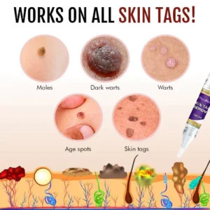 Oveallgo™ Tags & Moles Remover