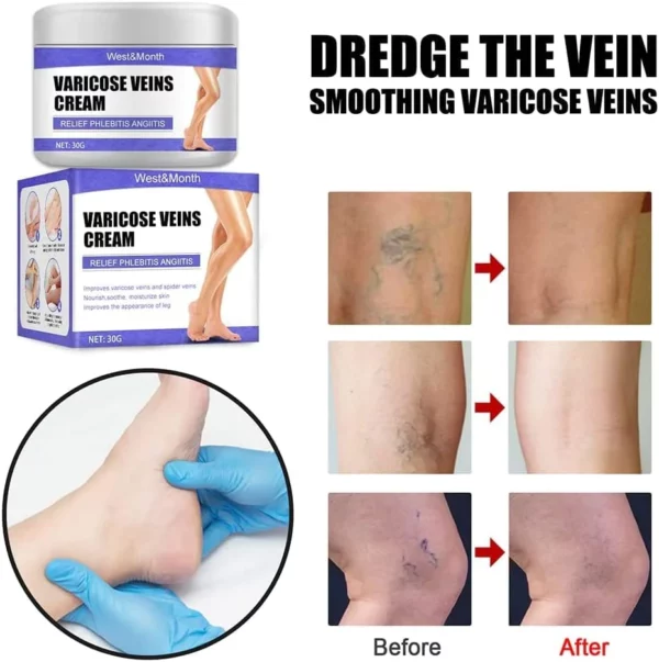 VeinRelief Varicose Treatment Cream