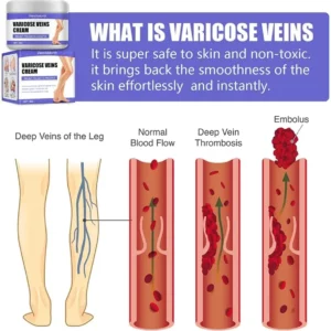 VeinRelief Varicose Treatment Cream