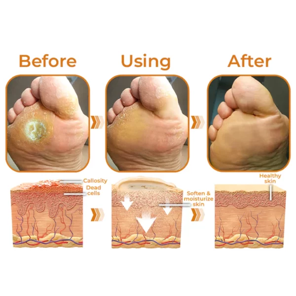 GFOUK™ Horse Oil Foot Callus Remedy Balm