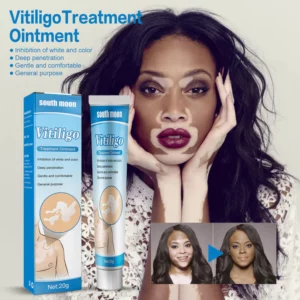 Vitiligo Treatment Ointment