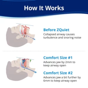 ZQuiet™ Anti-Snoring Mouthpiece