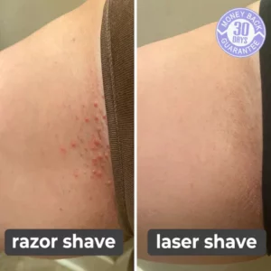 Laser Hair Remover 2.0