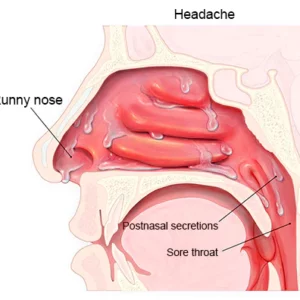 Nurbini™ RespiRelief red light nasal therapy device