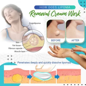 Dobshow™ Lipoma Removal Cream