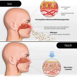 iRosesilk™ RespiRevive EMS Nasaltherapie-Instrument