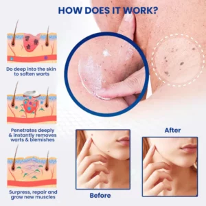 Dobshow™ WartsOff Instant Blemish Treatment Cream