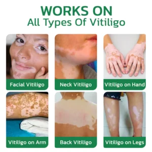 TreatVitiligo Soothing Cream