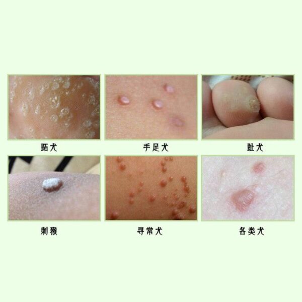 All Natural Skin Tag Removal Cream