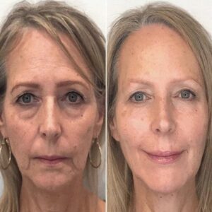 Botox Facial Essence