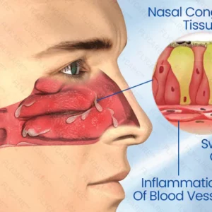 BreatheBright Nasal LED Therapy Device