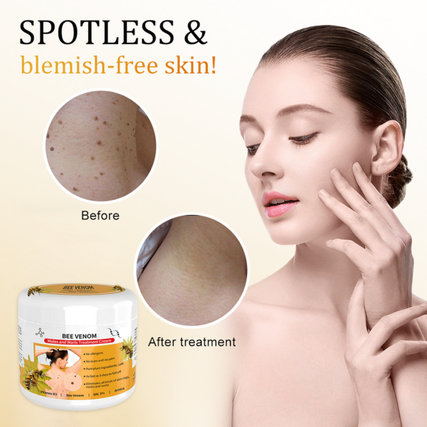 Posryst™ Bee Venom Mole and Wart Treatment Cream