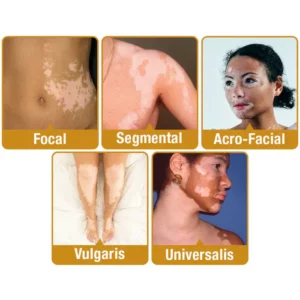 Vitiligo Treatment Cream