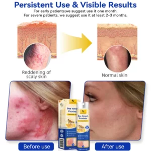 LOVILDS™ PsoriaHeal Bee Venom Psoriasis Treatment Spray pro