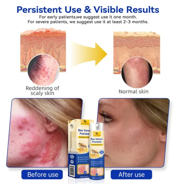 LOVILDS™ PsoriaHeal Bee Venom Psoriasis Treatment Spray pro