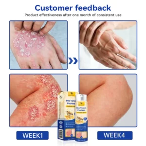 LOVILDS™ PsoriaHeal Bee Venom Psoriasis Treatment Spray pro