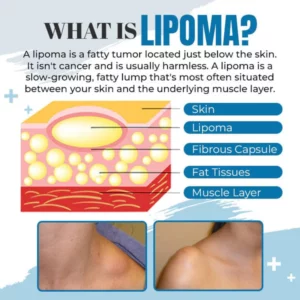 South Moon™ Lipoma Removal Ointment