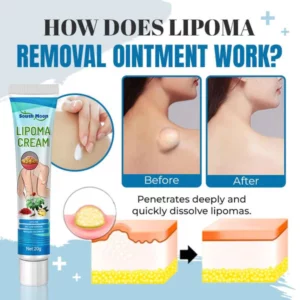 South Moon™ Lipoma Removal Ointment