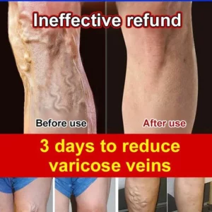 Varicose Vein Rapid Relief Cream