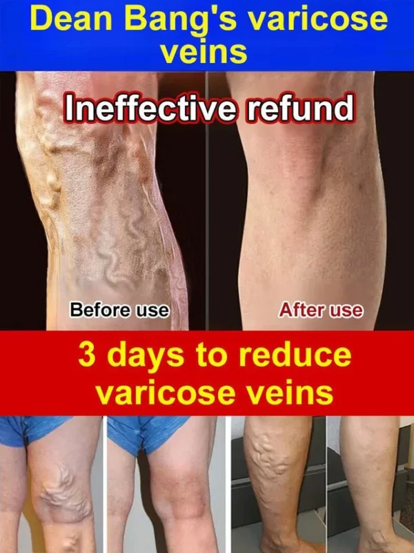 Varicose Vein Rapid Relief Cream