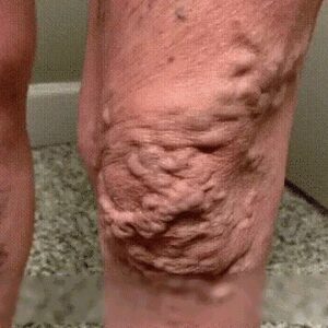 Varicose Vein Rapid Relief Cream