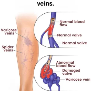 Varicose Vein Rapid Relief Cream