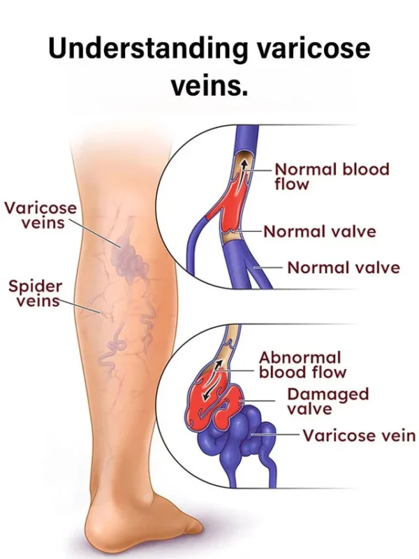 Varicose Vein Rapid Relief Cream