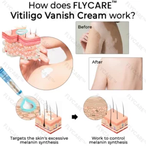 FLYCARE™ Vitiligo Vanish Cream