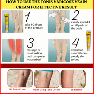 Tonis CREAM™ THE NEWLY DISCOVERED SOLUTION TO CLEAR ALL VARICOSE VEINS AND SPIDER VEINS!