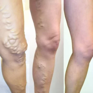 Varicose Veins Treatment Patches 12pcs