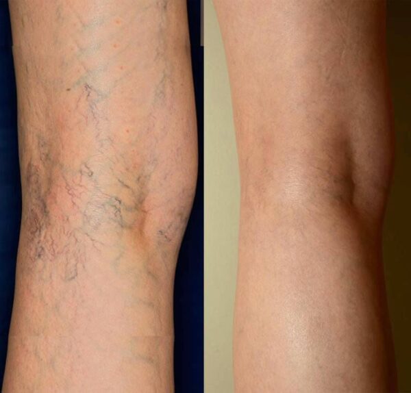 Banish™ Varicose Veins with Our Powerful Miracle Cream!