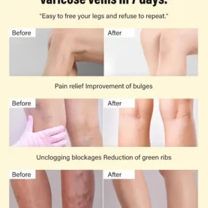 Varicose Vein Rapid Relief Cream