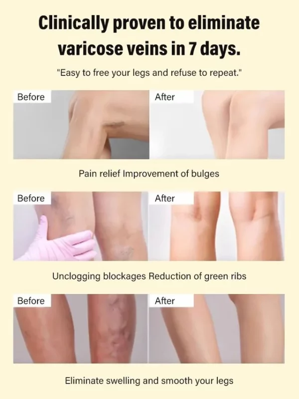 Varicose Vein Rapid Relief Cream