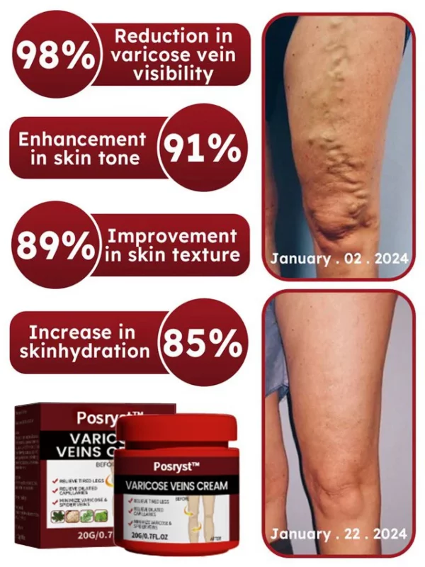 Varicose Vein Rapid Relief Cream