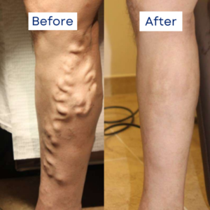 Banish™ Varicose Veins with Our Powerful Miracle Cream!