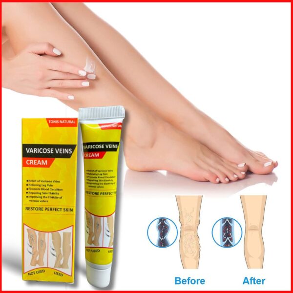 Tonis CREAM™ THE NEWLY DISCOVERED SOLUTION TO CLEAR ALL VARICOSE VEINS AND SPIDER VEINS!